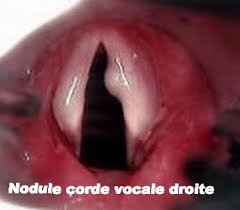 nodule corde vocale droite